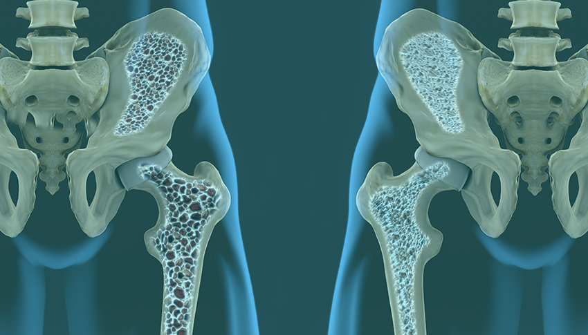Menopause and osteoporosis: what causes bone loss?